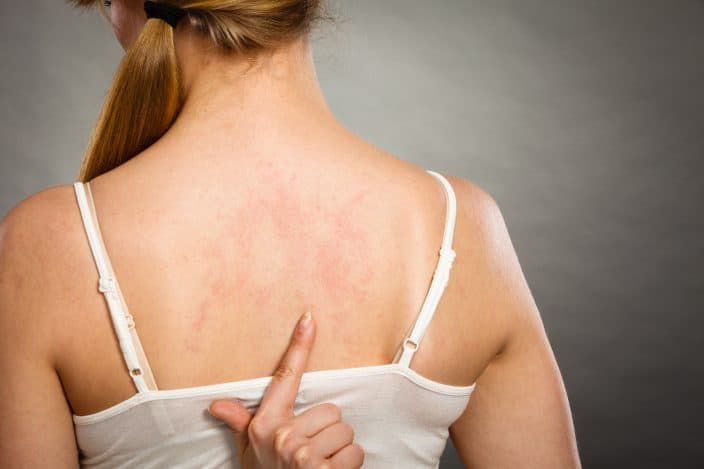 woman in a white tank top pointing at the red marks/rashes at her back from laying down on a wet beach towel. 